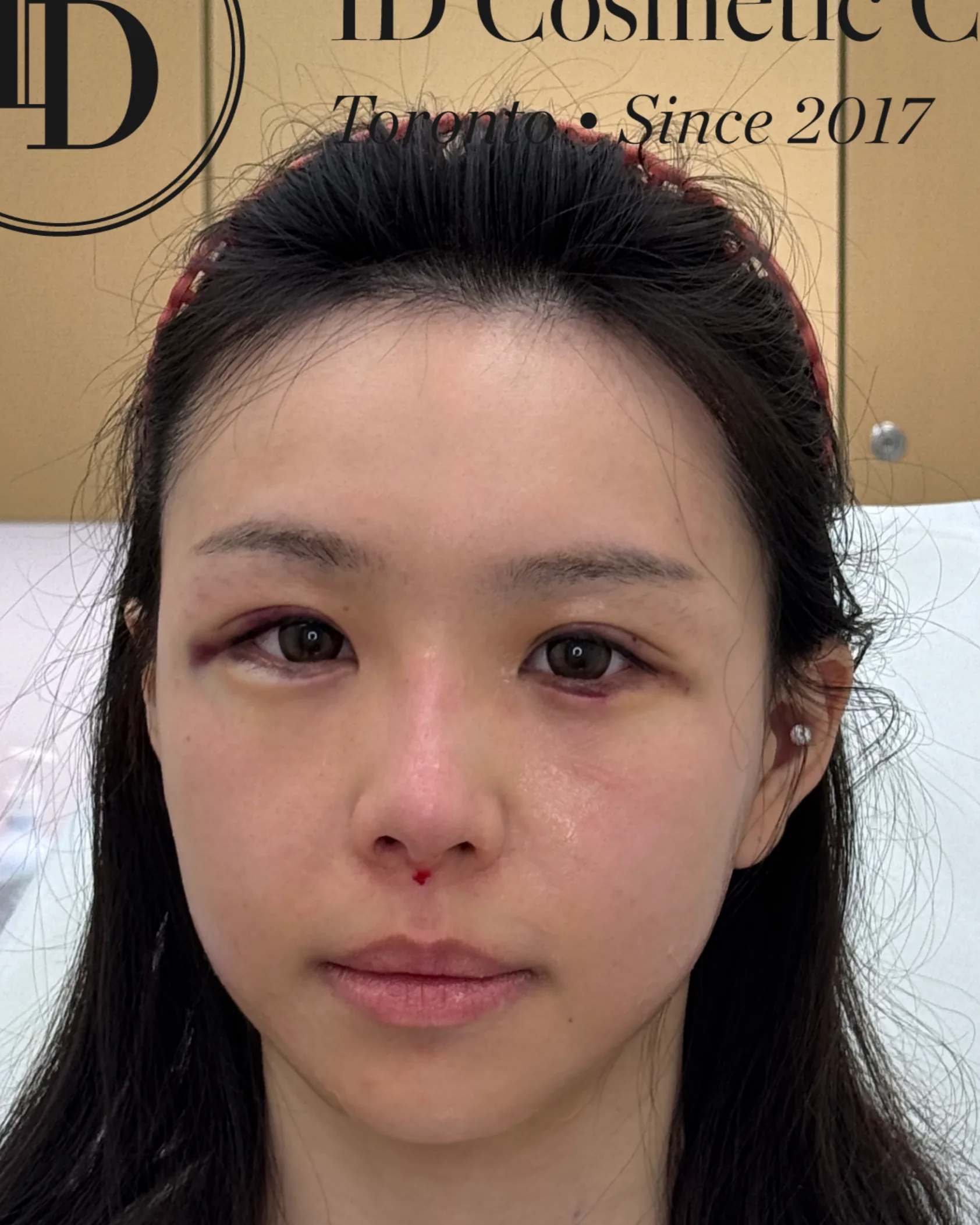 Upper Eyelid Ptosis · After Treatment · Case 05 · Luowei Medical Aesthetics Clinic
