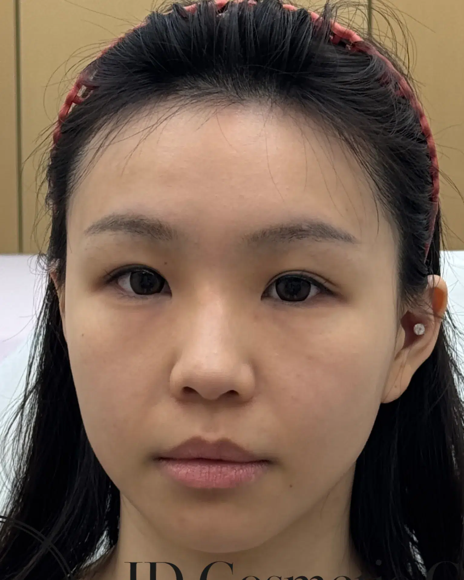 Upper Eyelid Ptosis · Before Treatment · Case 05 · Luowei Medical Aesthetics Clinic
