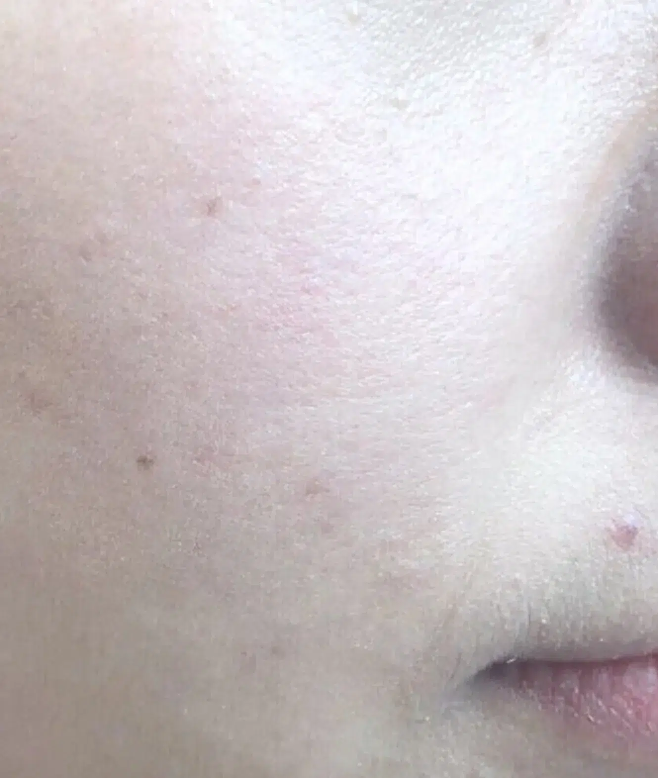 Dull Skin Tone — After Treatment · Case 2 · Luowei Medical Aesthetics Clinic