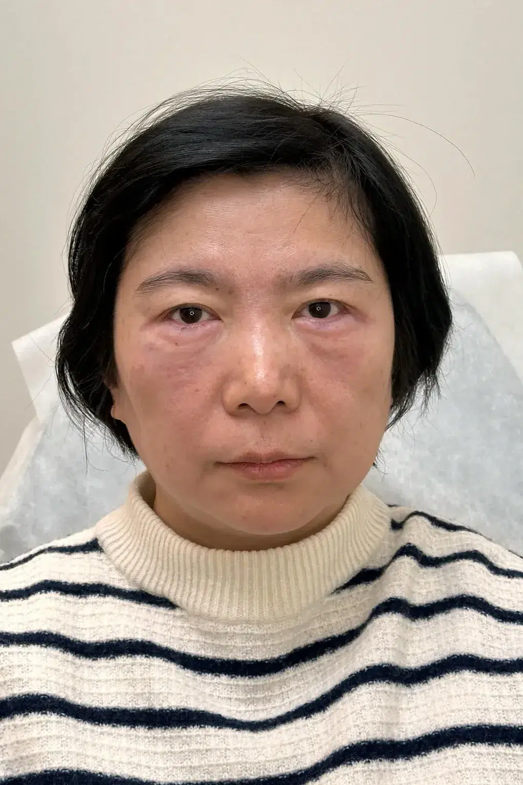 Under-eye bags & dark circles After · Case 6 · Luowei Medical Aesthetics Clinic