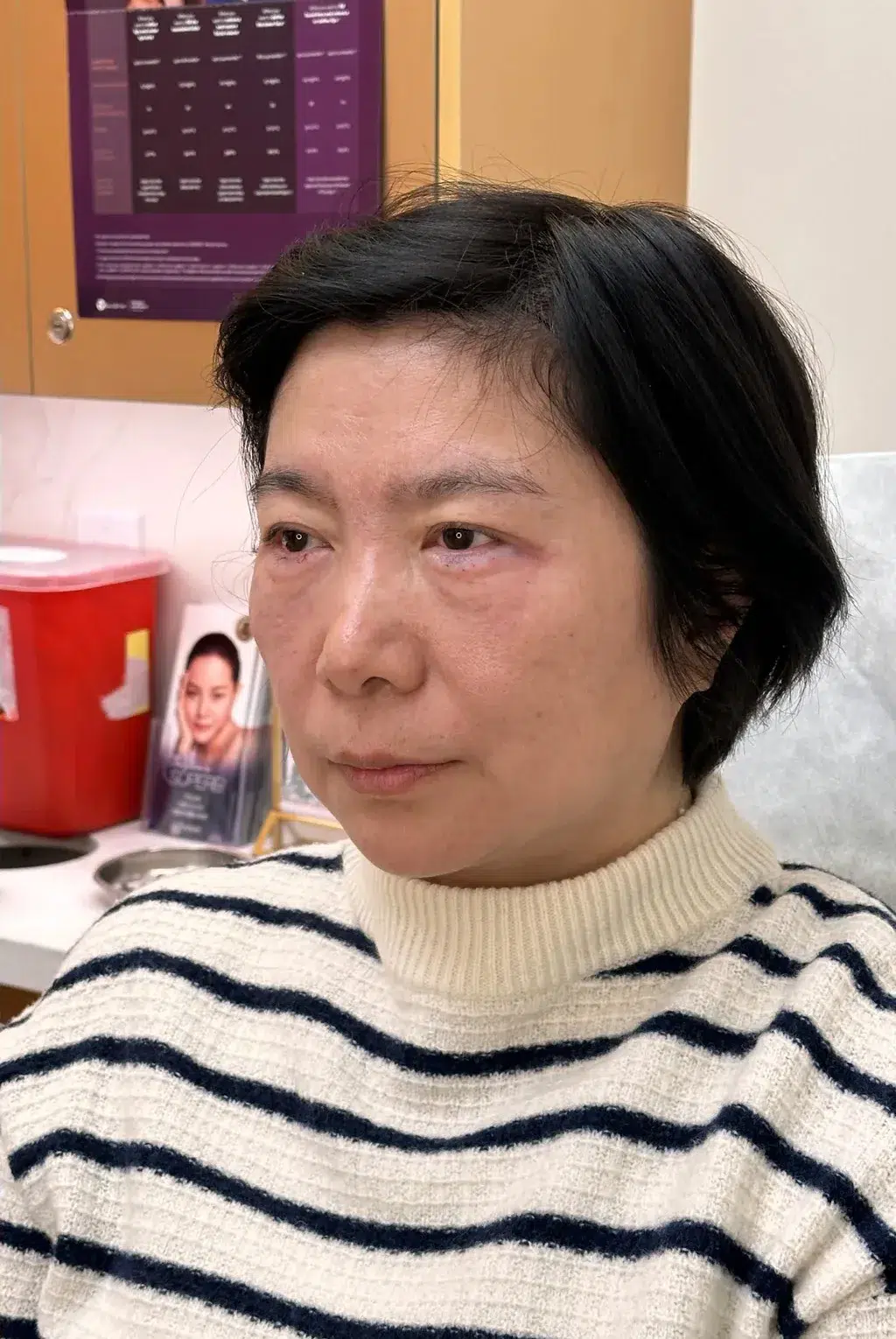 Under-eye bags & dark circles — After · Case 13 · Luowei