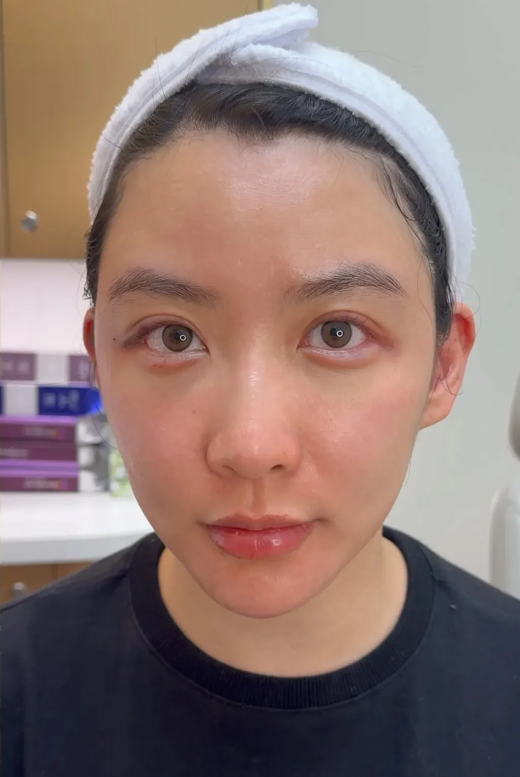 Under-Eye Bags & Dark Circles, After · Case 19 · Luowei Medical Aesthetics Clinic