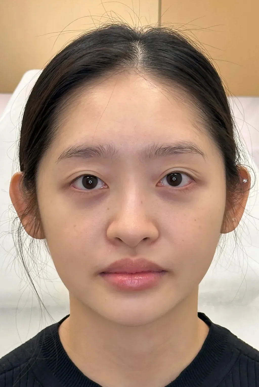 Under-eye bags & dark circles · after · Case 25 · Luowei Medical Aesthetics Clinic