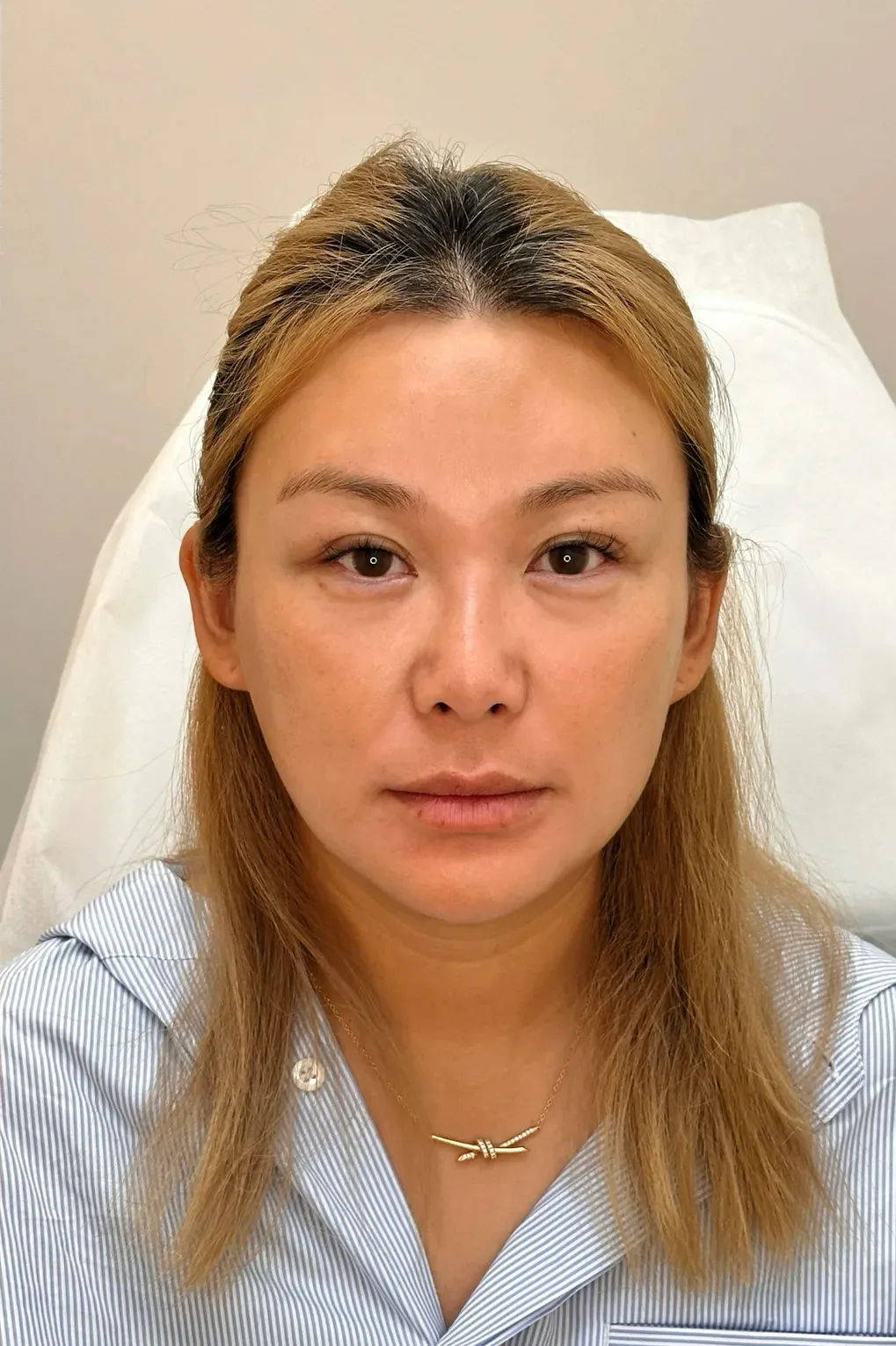 Under-eye bags & dark circles After · Case 30 · Luowei Medical Aesthetics Clinic