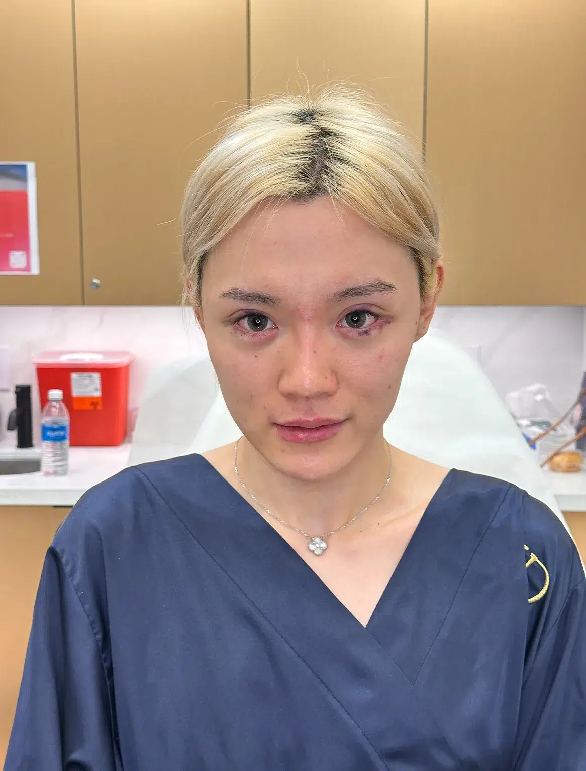 Under-eye bags & dark circles — After · Case 33 · Luowei