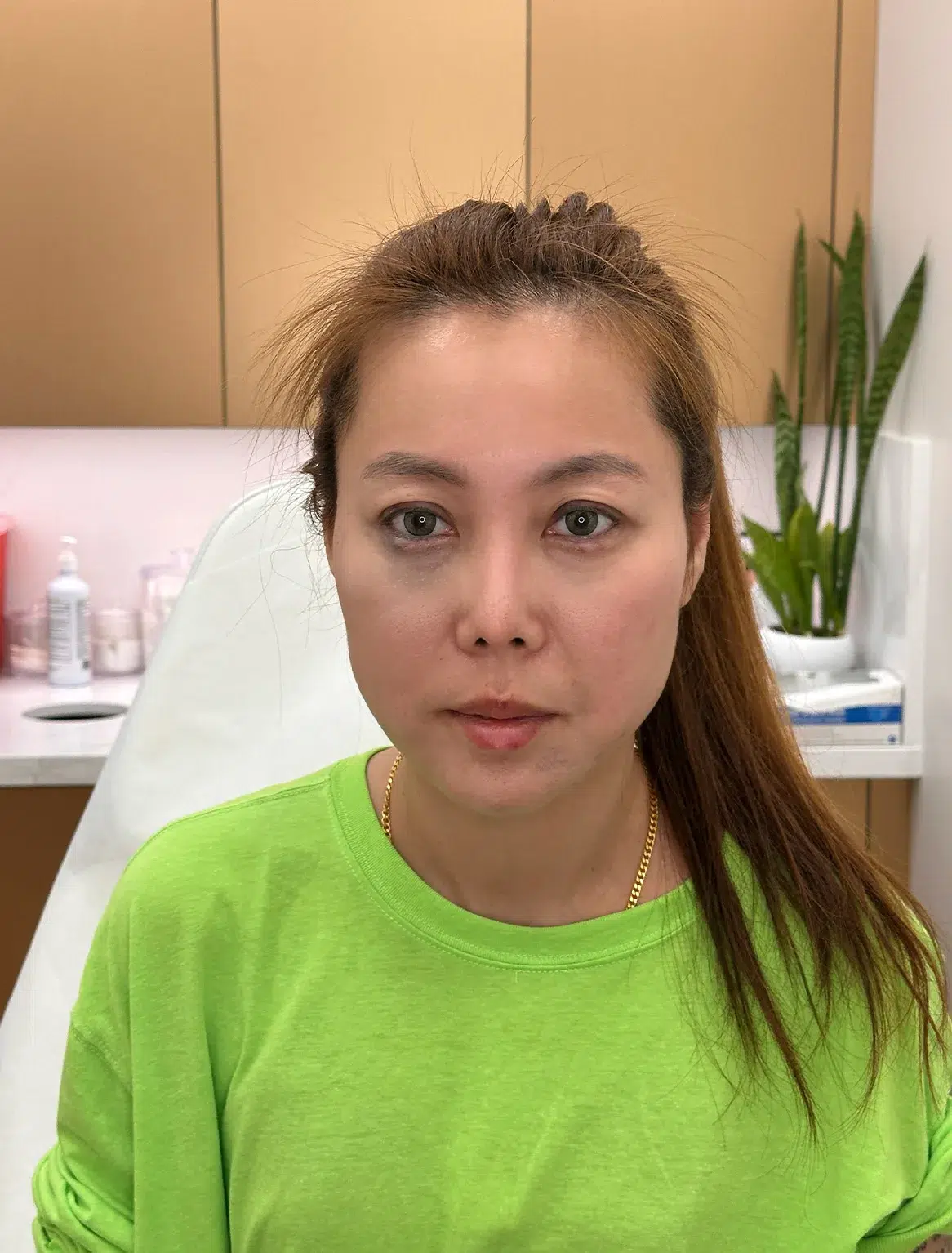 Under-Eye Bags & Dark Circles — After · Case 35 · Luowei Medical Aesthetics Clinic
