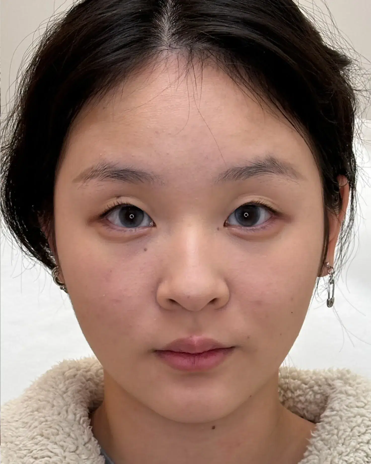 Under-Eye Bags & Dark Circles — After · Case 56 · Luowei Medical Aesthetics Clinic