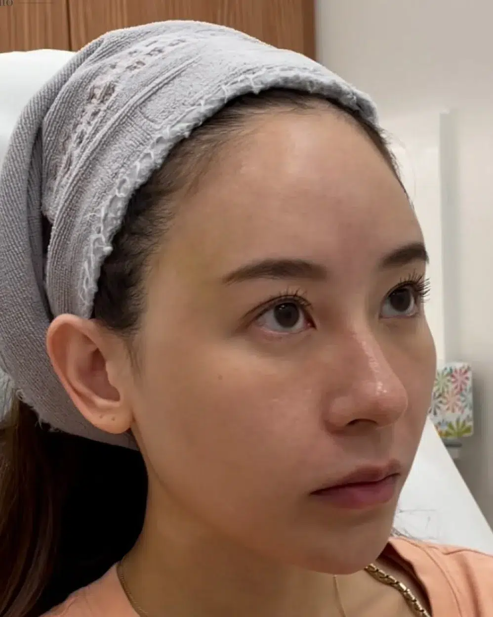 Under-Eye Bags & Dark Circles, After · Case 104 · Luowei Medical Aesthetics Clinic