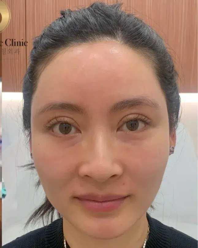 Eye Bags & Dark Circles After · Case 106 · Luowei Medical Aesthetics Clinic