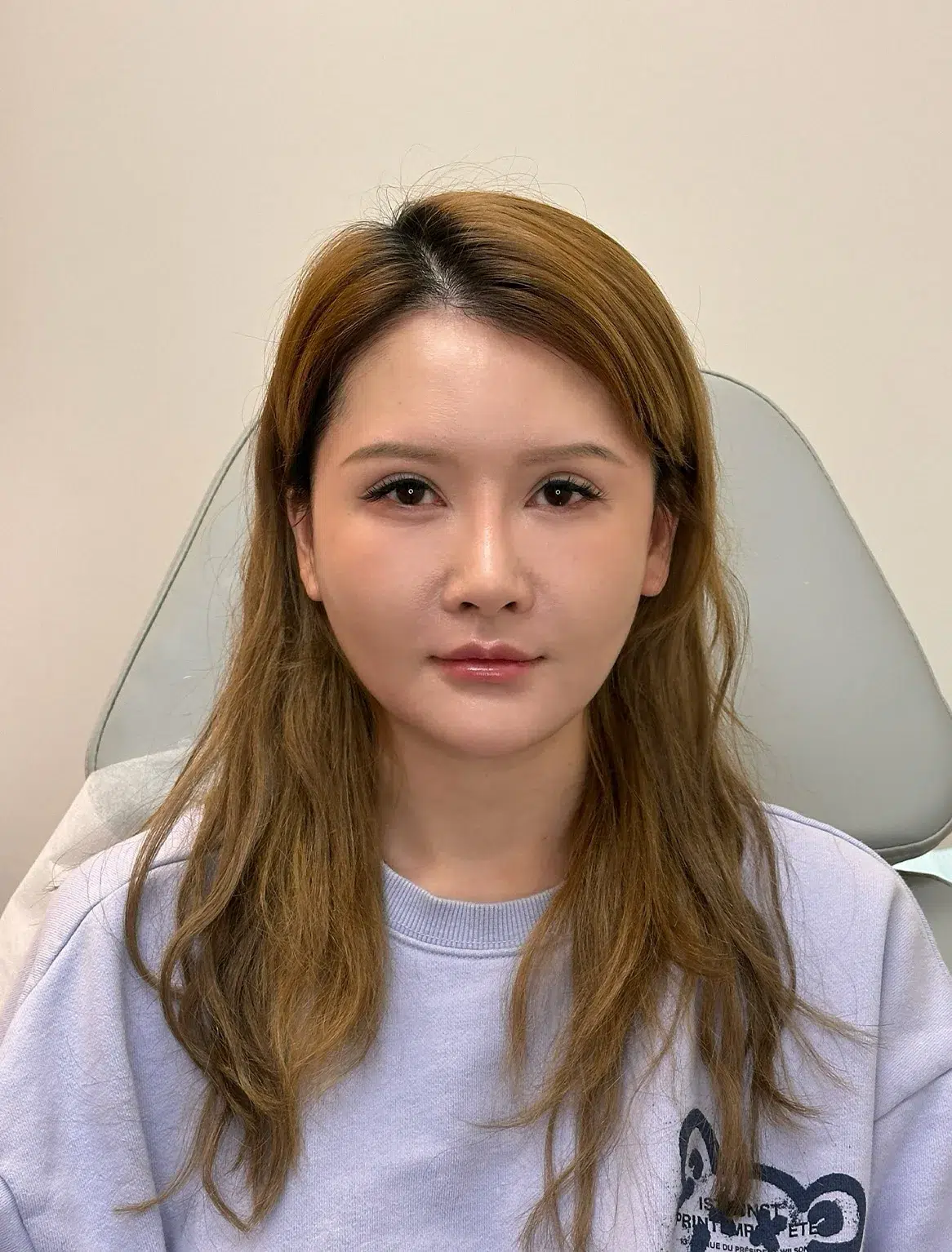 Under-Eye Bags & Dark Circles, After · Case 38 · Luowei Medical Aesthetics Clinic