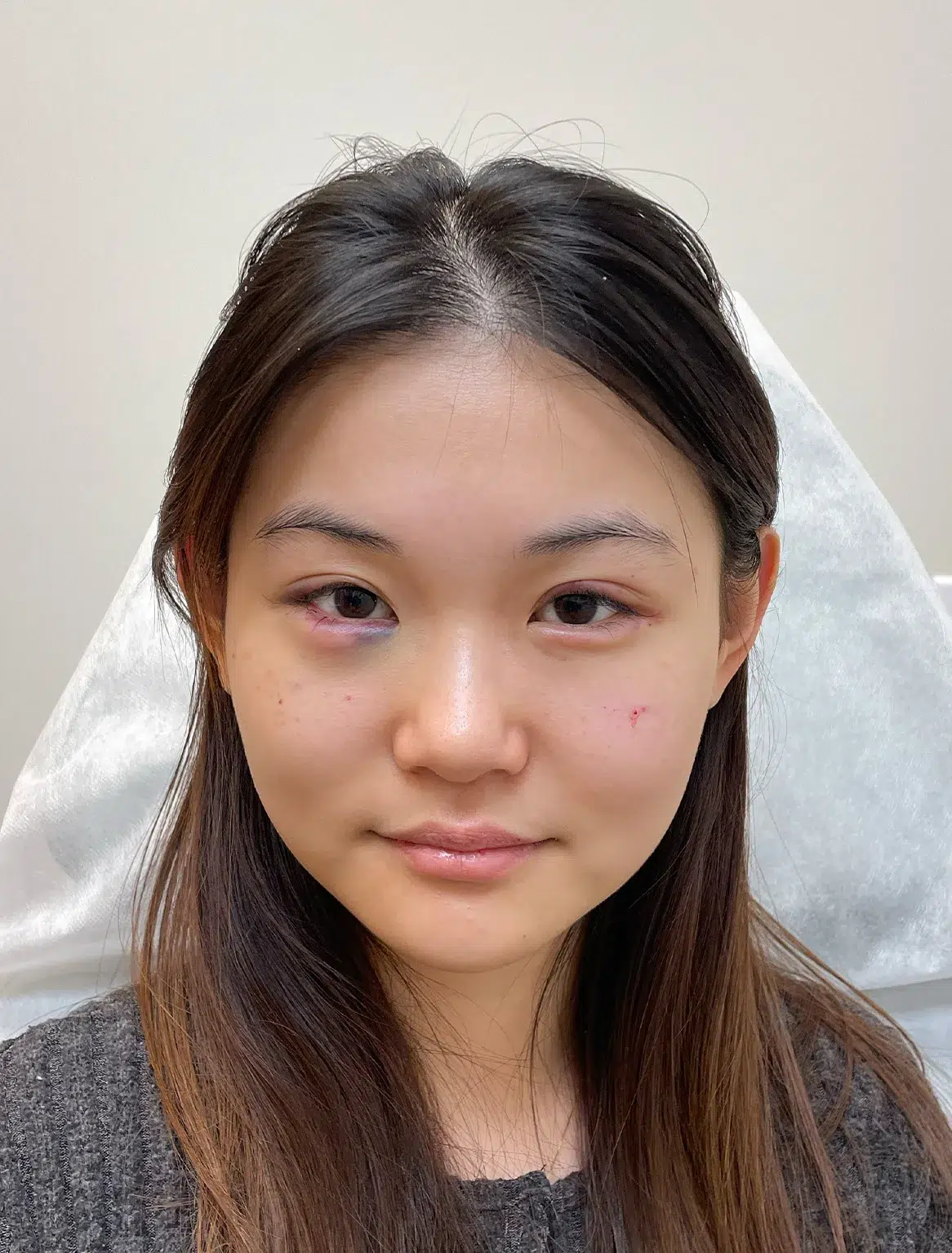 Under-eye bags & dark circles · after · Case 41 · Luowei Medical Aesthetics Clinic