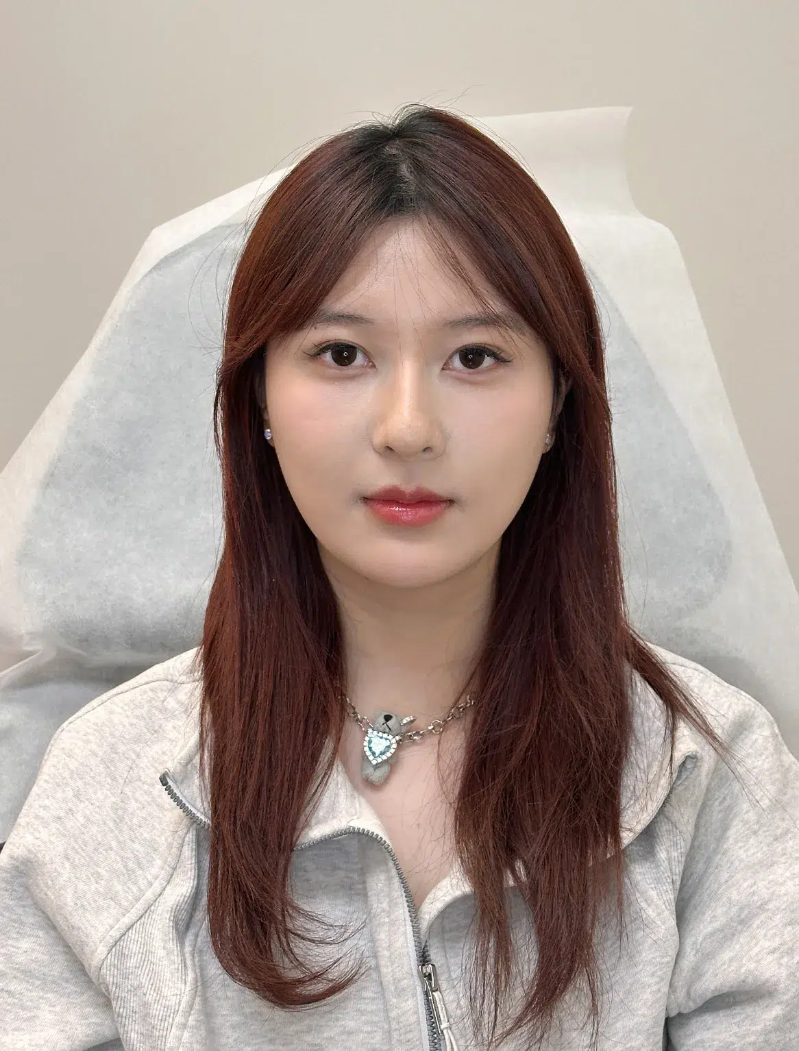 Under-eye bags & dark circles After · Case 46 · Luowei Medical Aesthetics Clinic