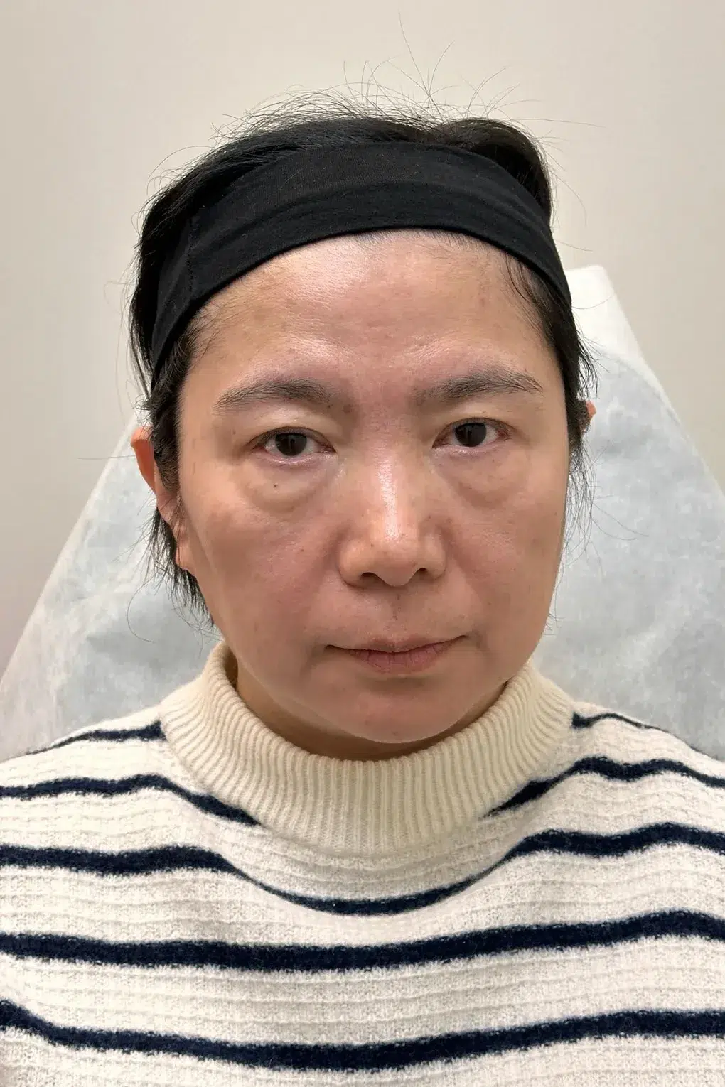 Under-eye bags & dark circles · before · Case 6 · Luowei Medical Aesthetics Clinic