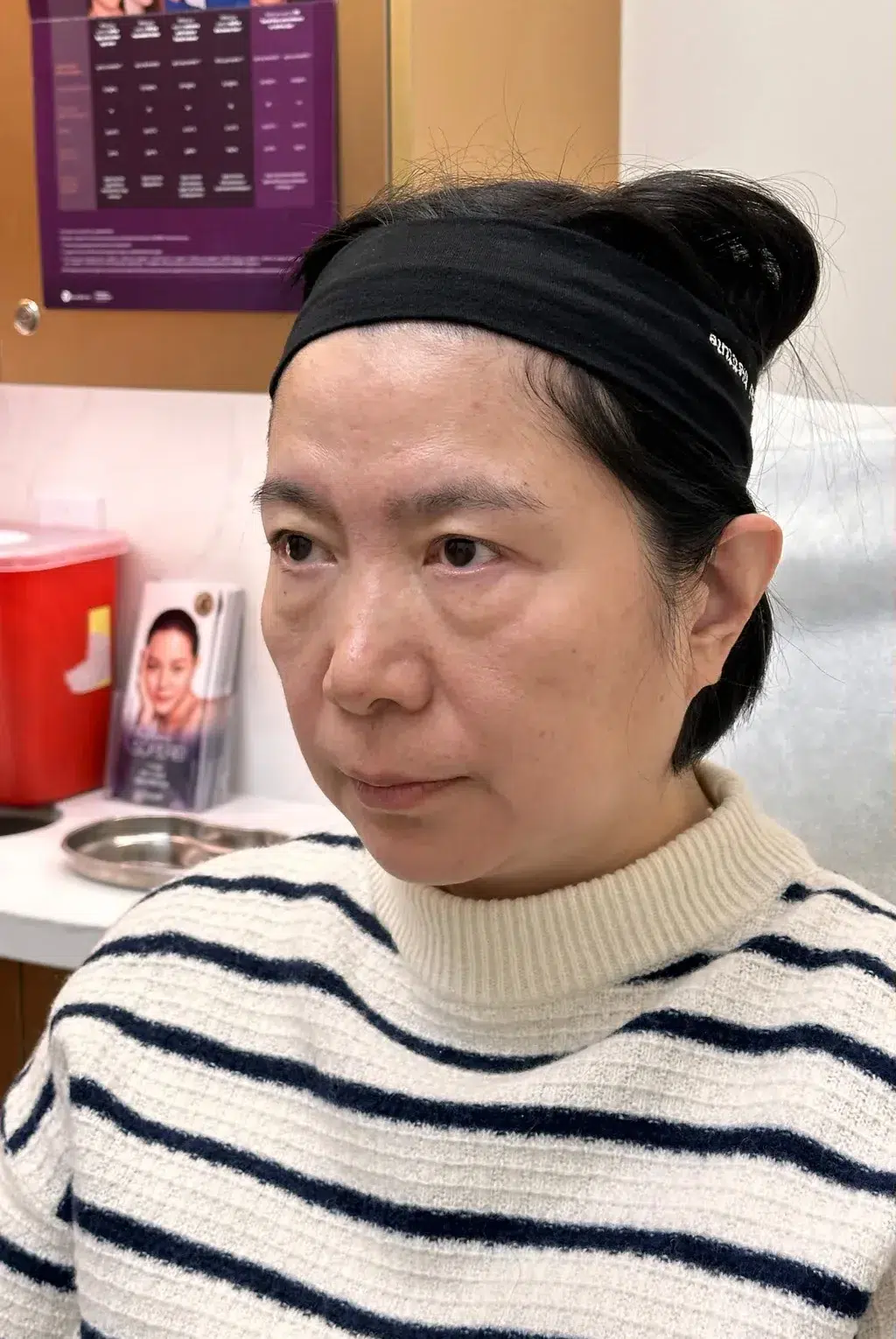 Under-eye bags & dark circles Before · Case 13 · Luowei Medical Aesthetics Clinic