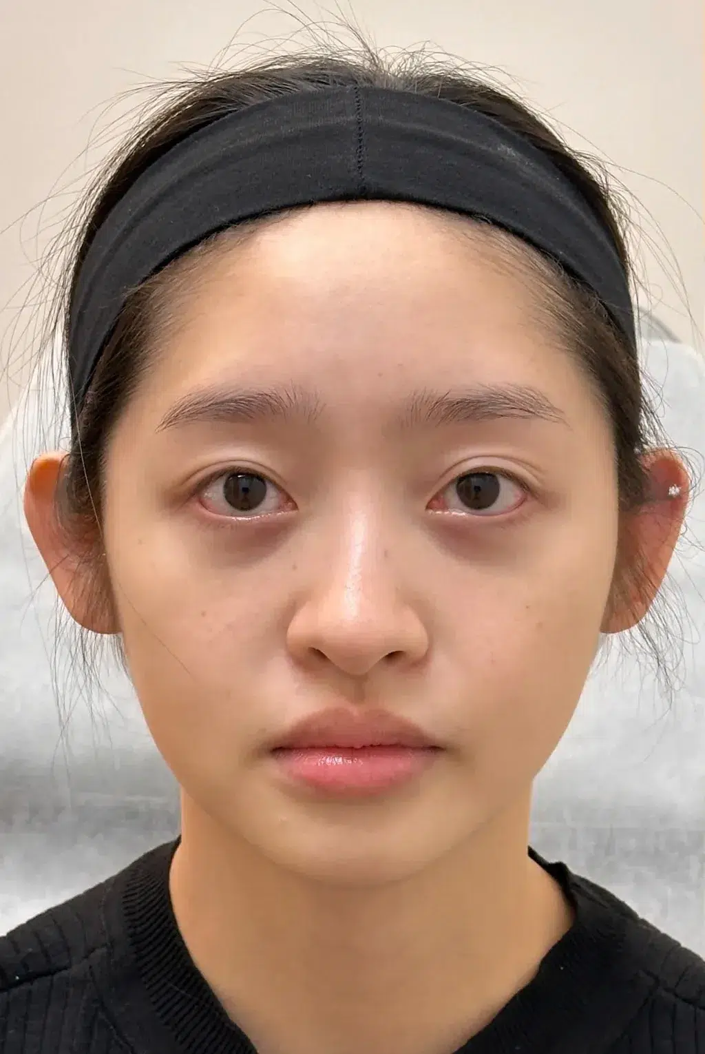 Under-Eye Bags & Dark Circles, Before · Case 25 · Luowei Medical Aesthetics Clinic