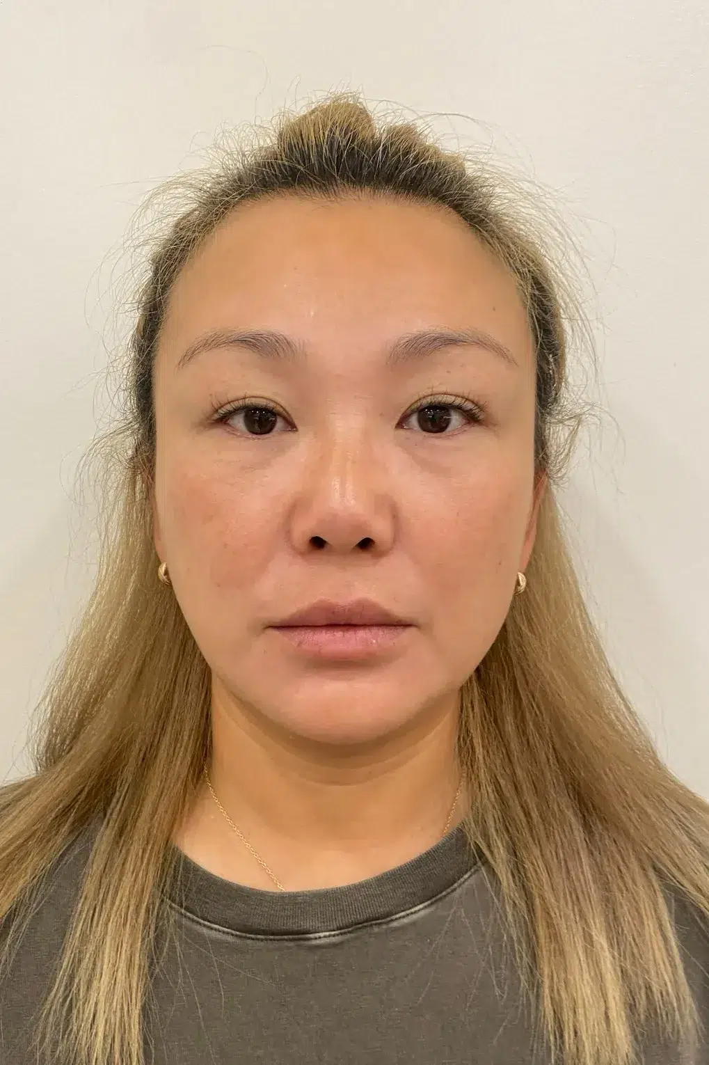 Under-eye bags & dark circles · before · Case 30 · Luowei Medical Aesthetics Clinic