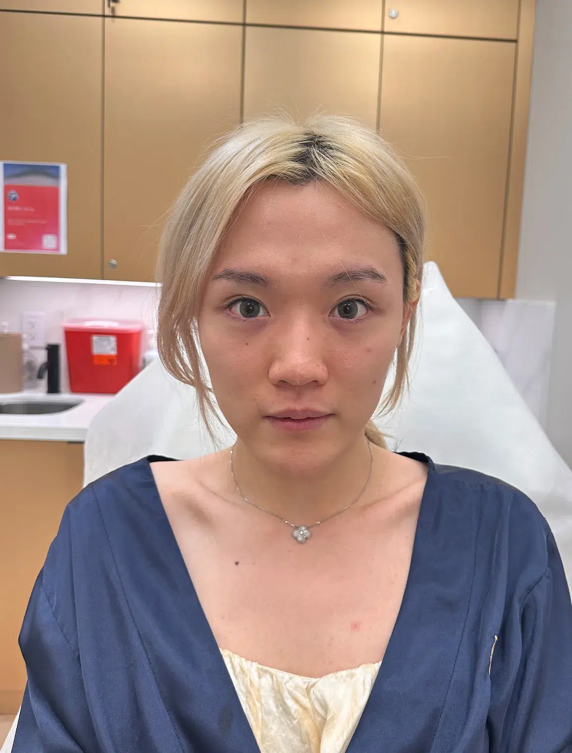 Under-eye bags & dark circles Before · Case 33 · Luowei Medical Aesthetics Clinic