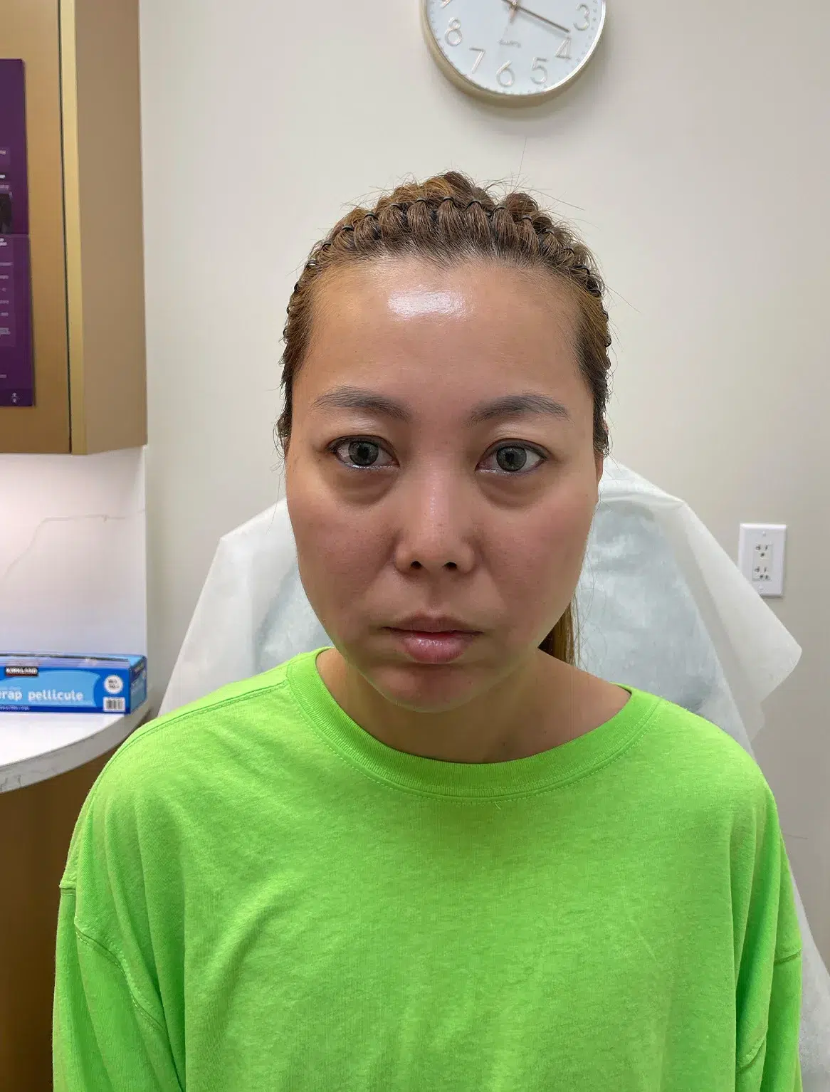Under-eye bags & dark circles — Before · Case 35 · Luowei