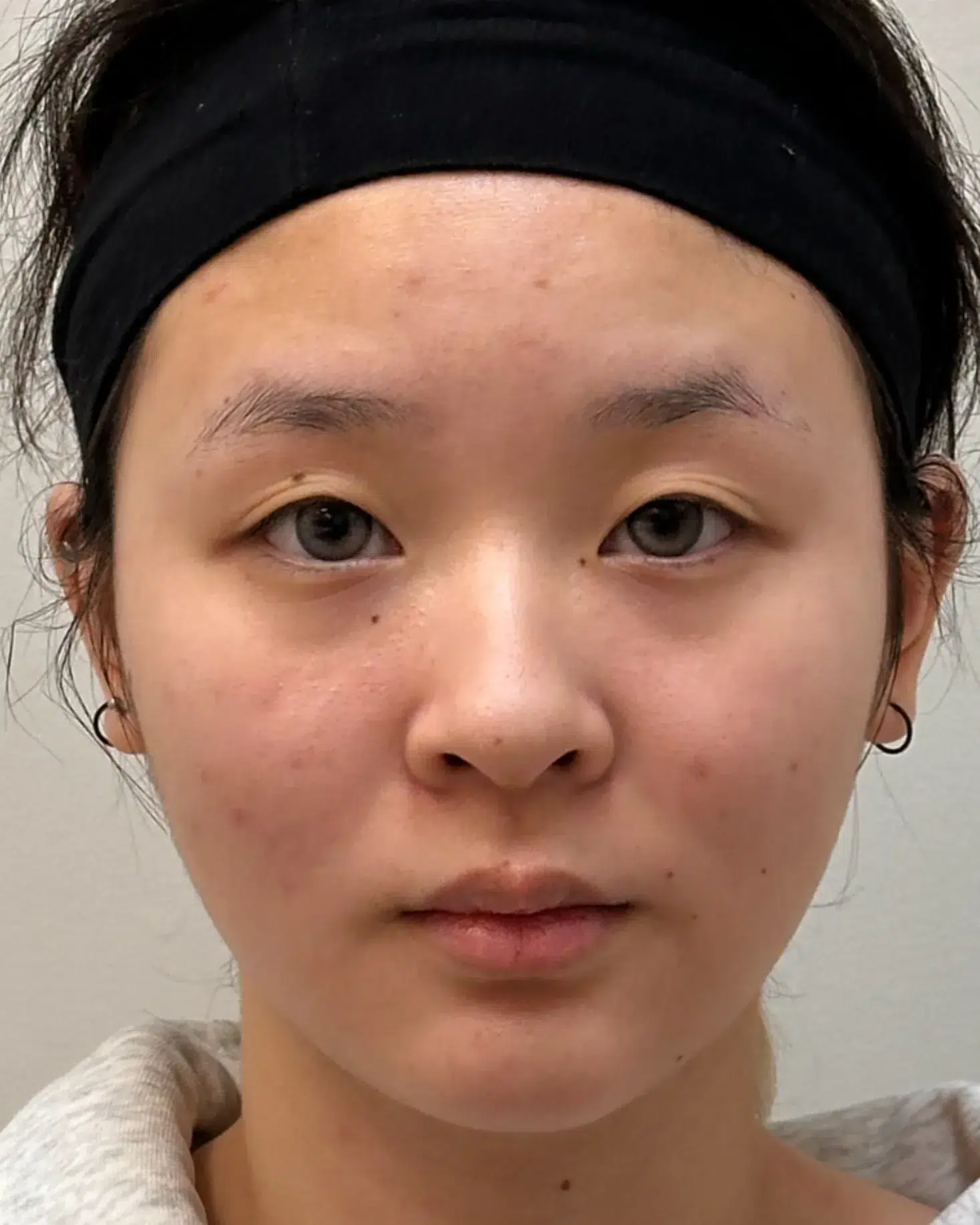 Under-eye bags & dark circles · before · Case 56 · Luowei Medical Aesthetics Clinic