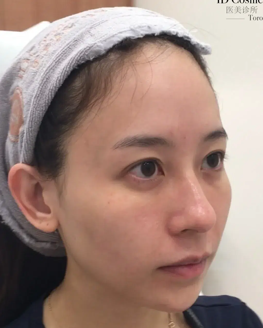 Eye bags & dark circles, before treatment · Case 104 · Luowei Medical Aesthetics Clinic