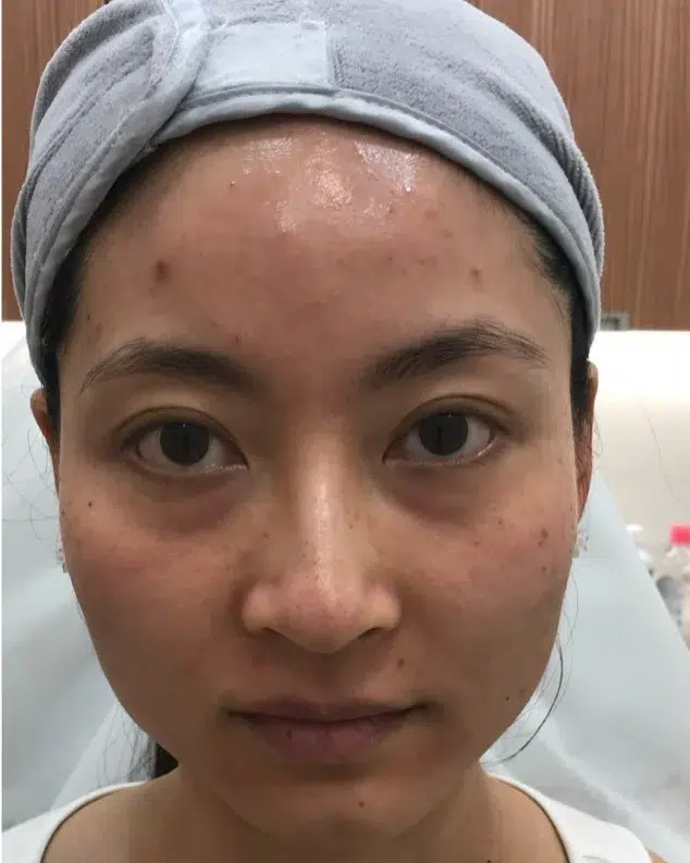 Under-Eye Bags & Dark Circles, Before · Case 106 · Luowei Medical Aesthetics Clinic