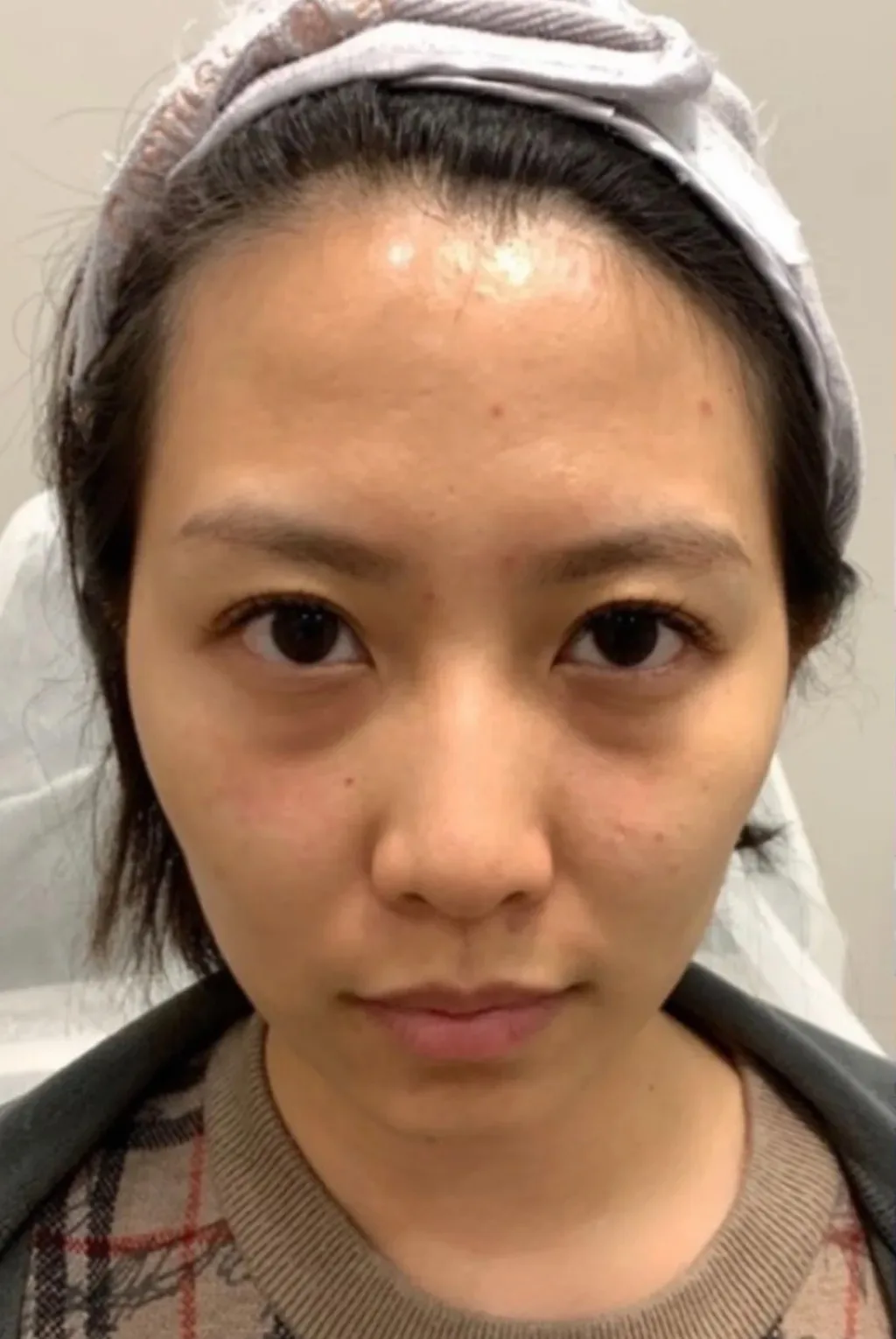 Under-eye bags & dark circles — Before · Case 57 · Luowei