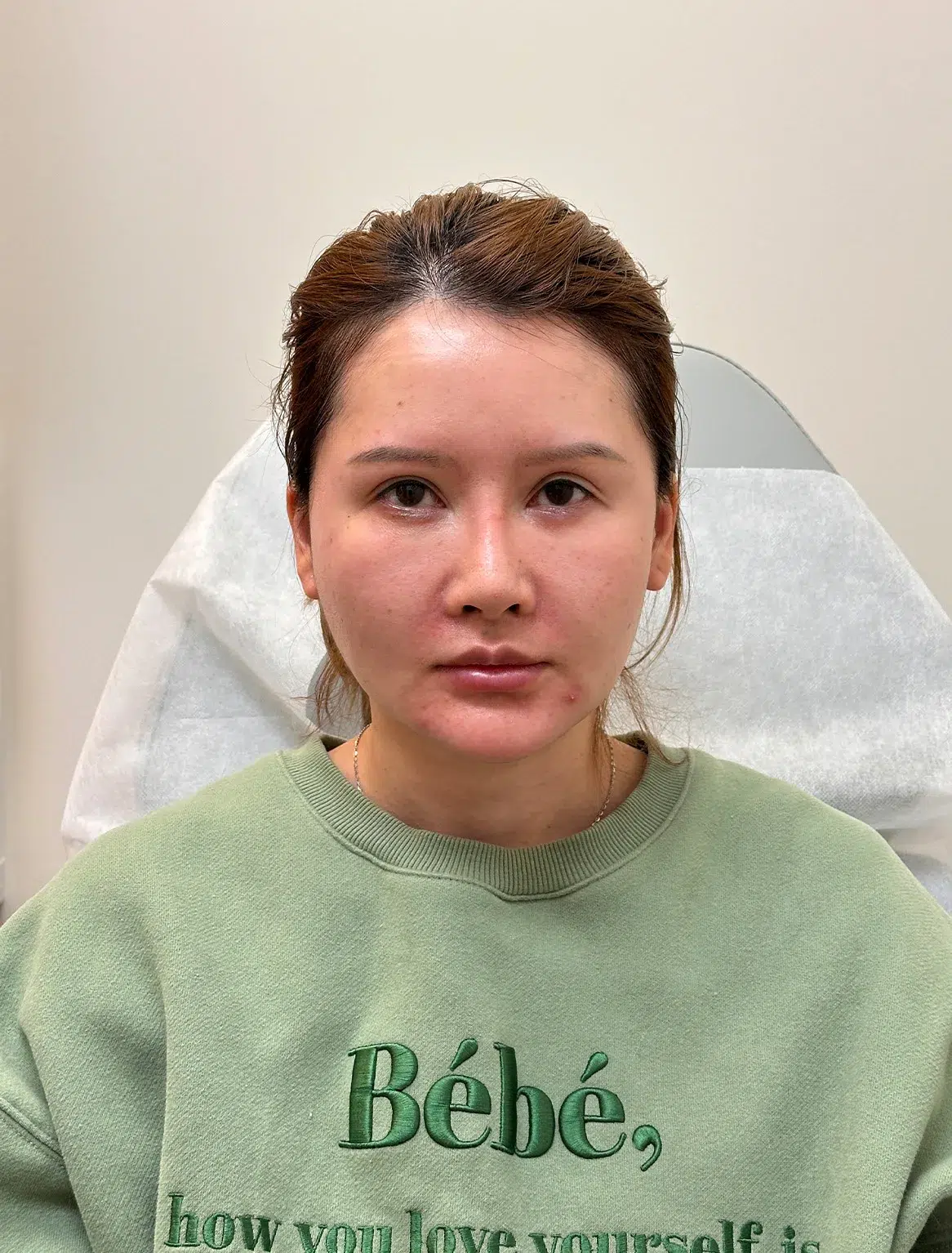 Under-Eye Bags & Dark Circles — Before · Case 38 · Luowei Medical Aesthetics Clinic