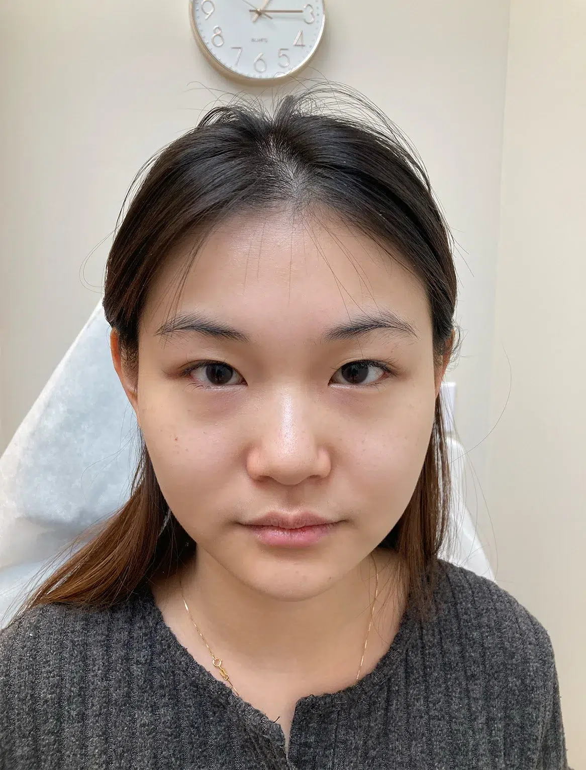Under-Eye Bags & Dark Circles, Before · Case 41 · Luowei Medical Aesthetics Clinic
