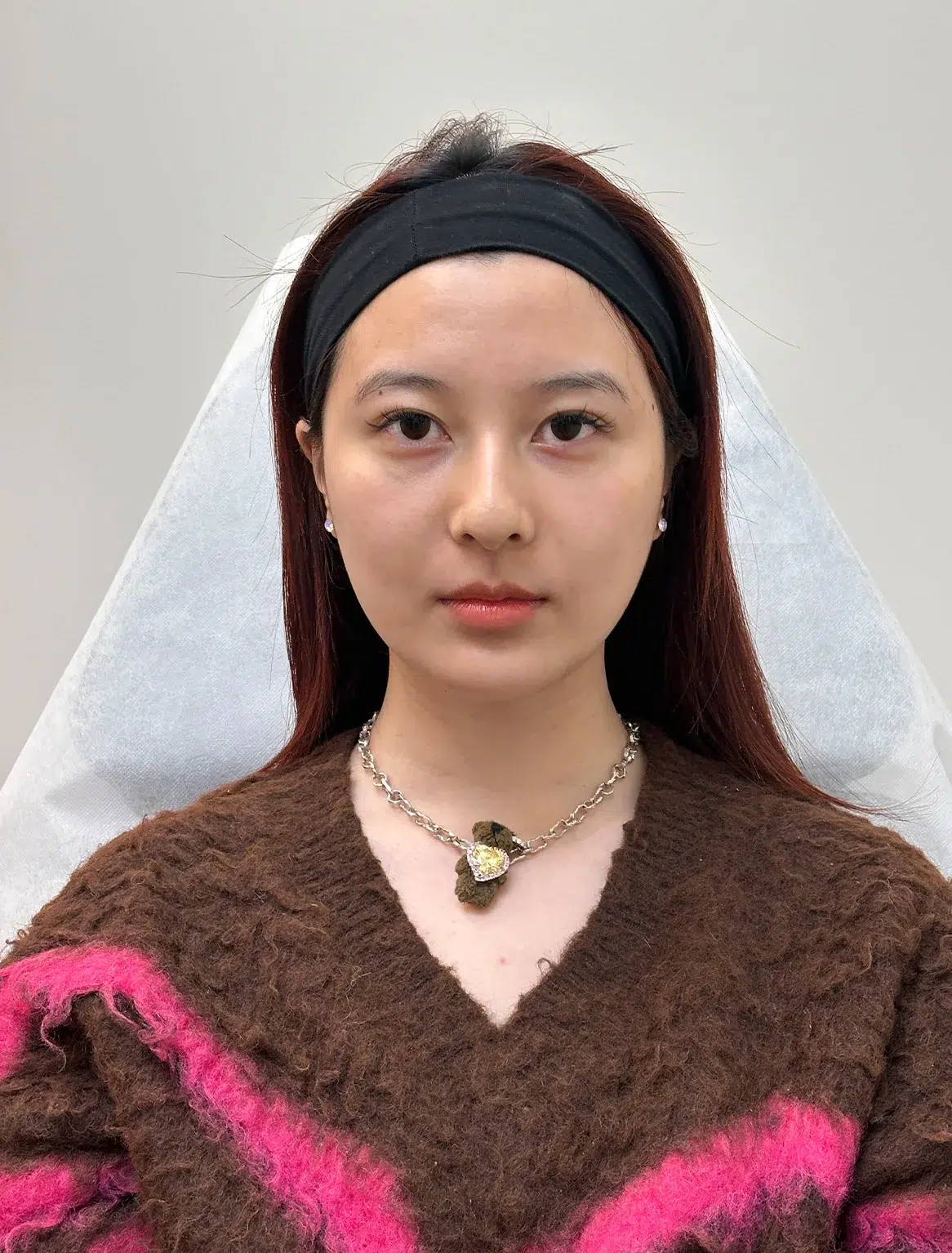 Under-eye bags & dark circles · before · Case 46 · Luowei Medical Aesthetics Clinic