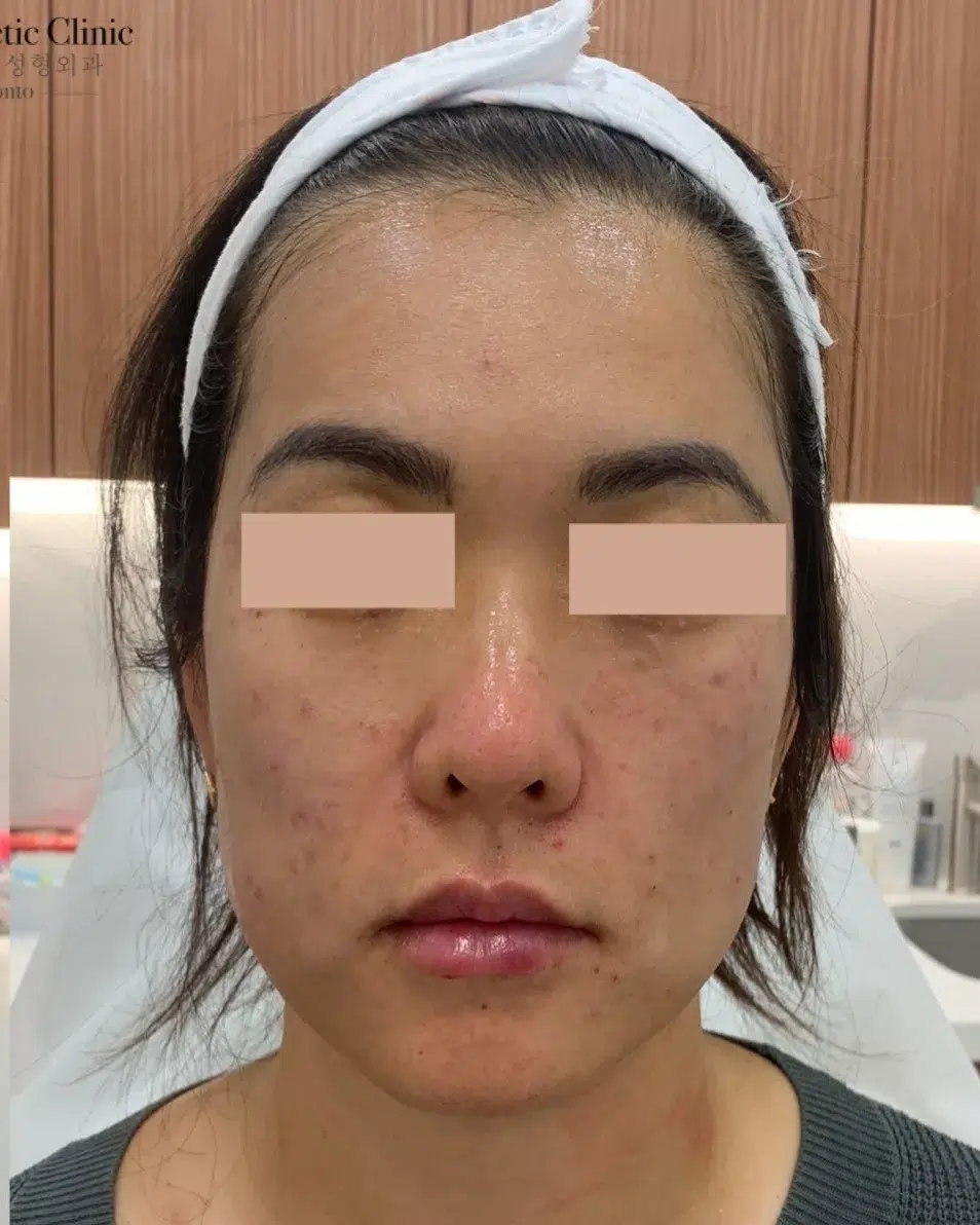 Jowls/sagging lower face — After · Case 8 · Luowei
