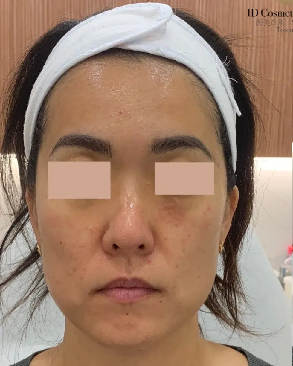 Jowls/sagging Before · Case 8 · Luowei Medical Aesthetics Clinic