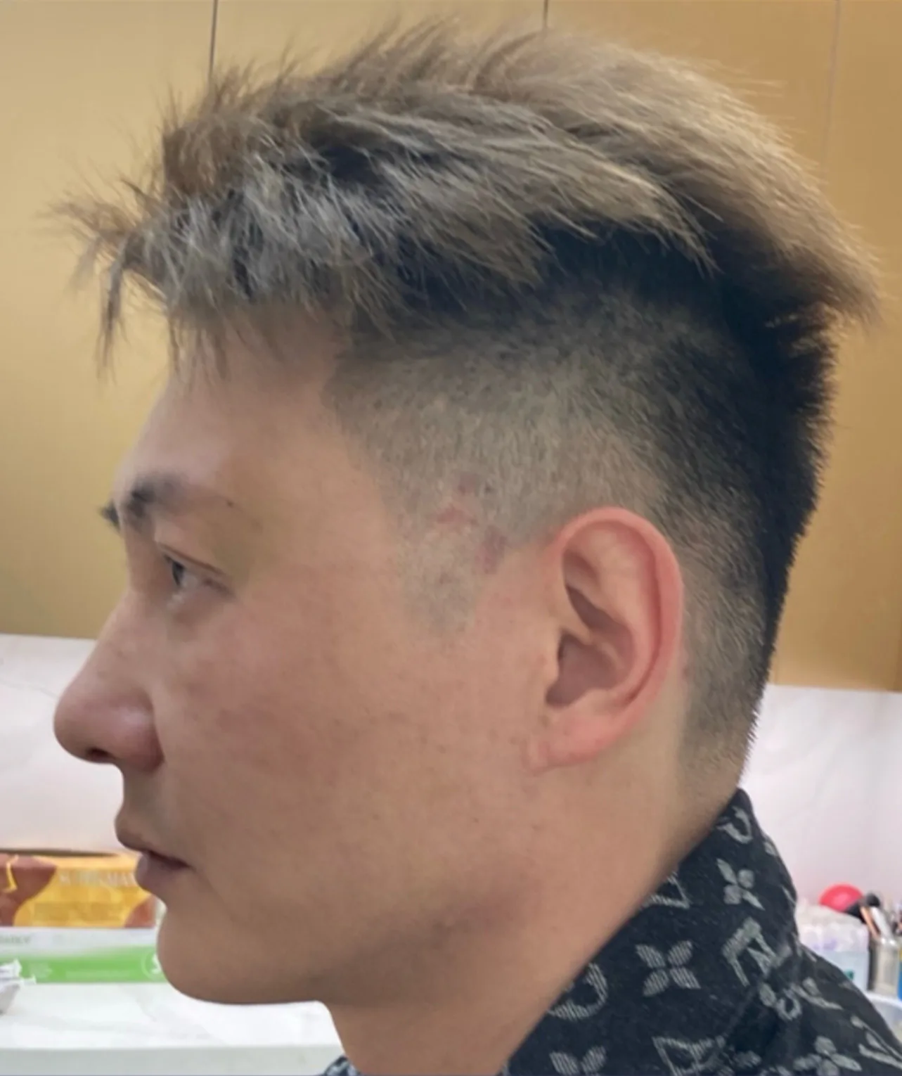 Face Shape: Round Face / Flat Face / Facial Contour — After · Case 20 · Luowei Medical Aesthetics Clinic