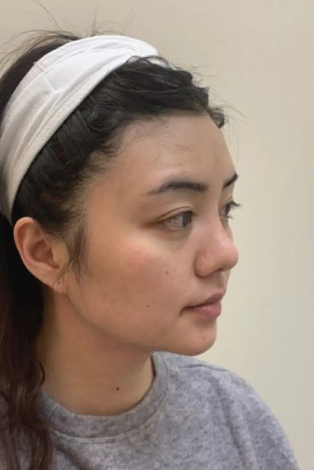 Face Shape: Round Face / Flat Face / Facial Contour, After · Case 27 · Luowei Medical Aesthetics Clinic