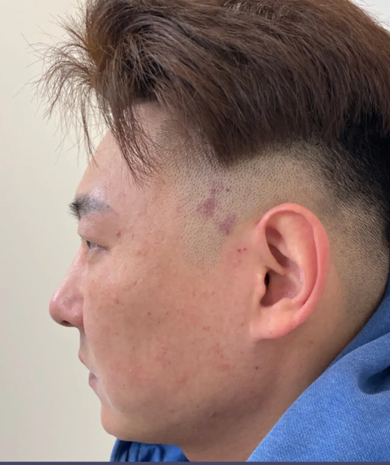 Facial shape (round/flat/contour) Before · Case 20 · Luowei Medical Aesthetics Clinic