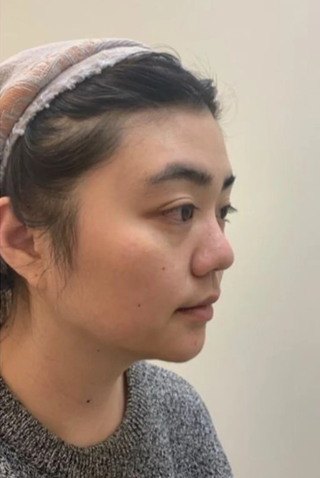 Face shape: round/flat face/facial contour — Before · Case 27 · Luowei