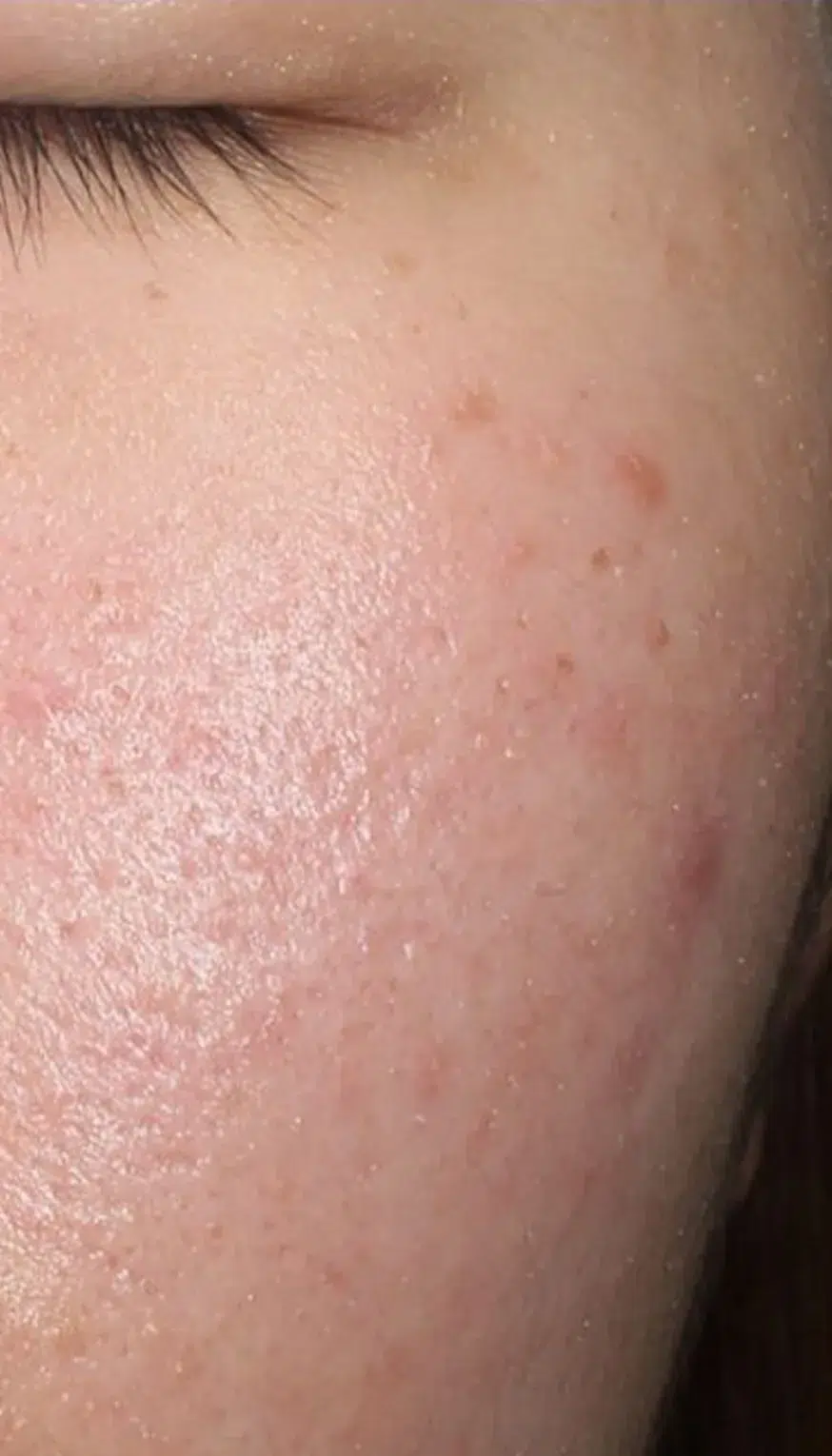 Sensitive skin after treatment · Case 01 · Luowei Medical Aesthetics Clinic