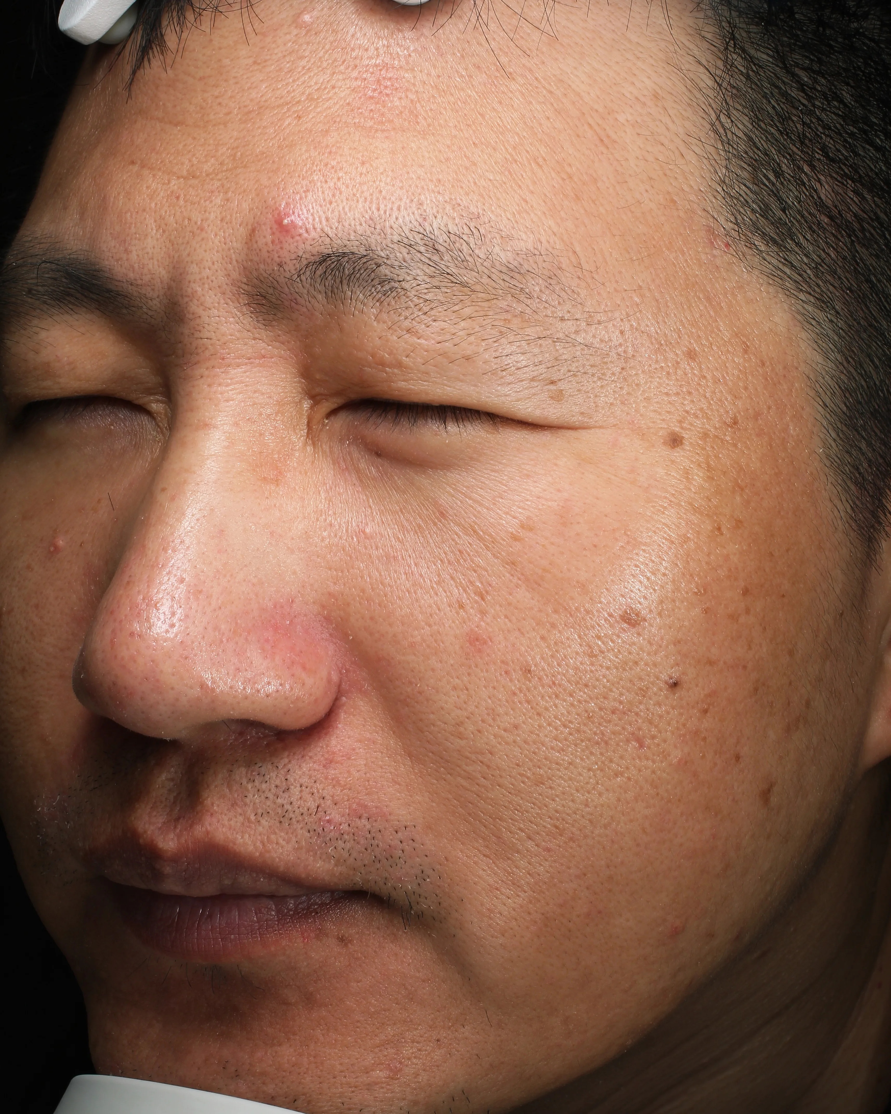 Sensitive Skin After · Case 03 · Luowei Medical Aesthetics Clinic