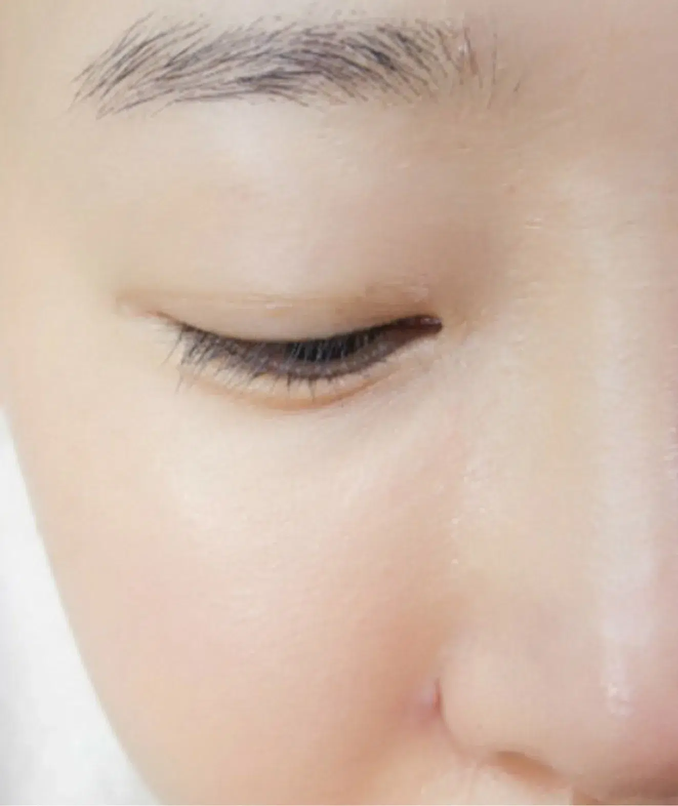 Facial Redness & Visible Capillaries — After Treatment · Case 11 · Luowei Medical Aesthetics Clinic