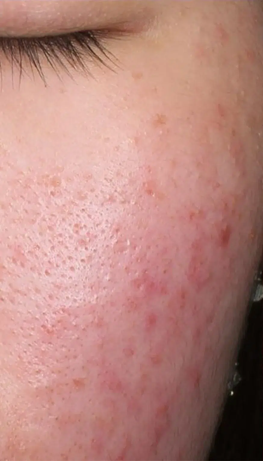 Sensitive Skin Before · Case 01 · Luowei Medical Aesthetics Clinic