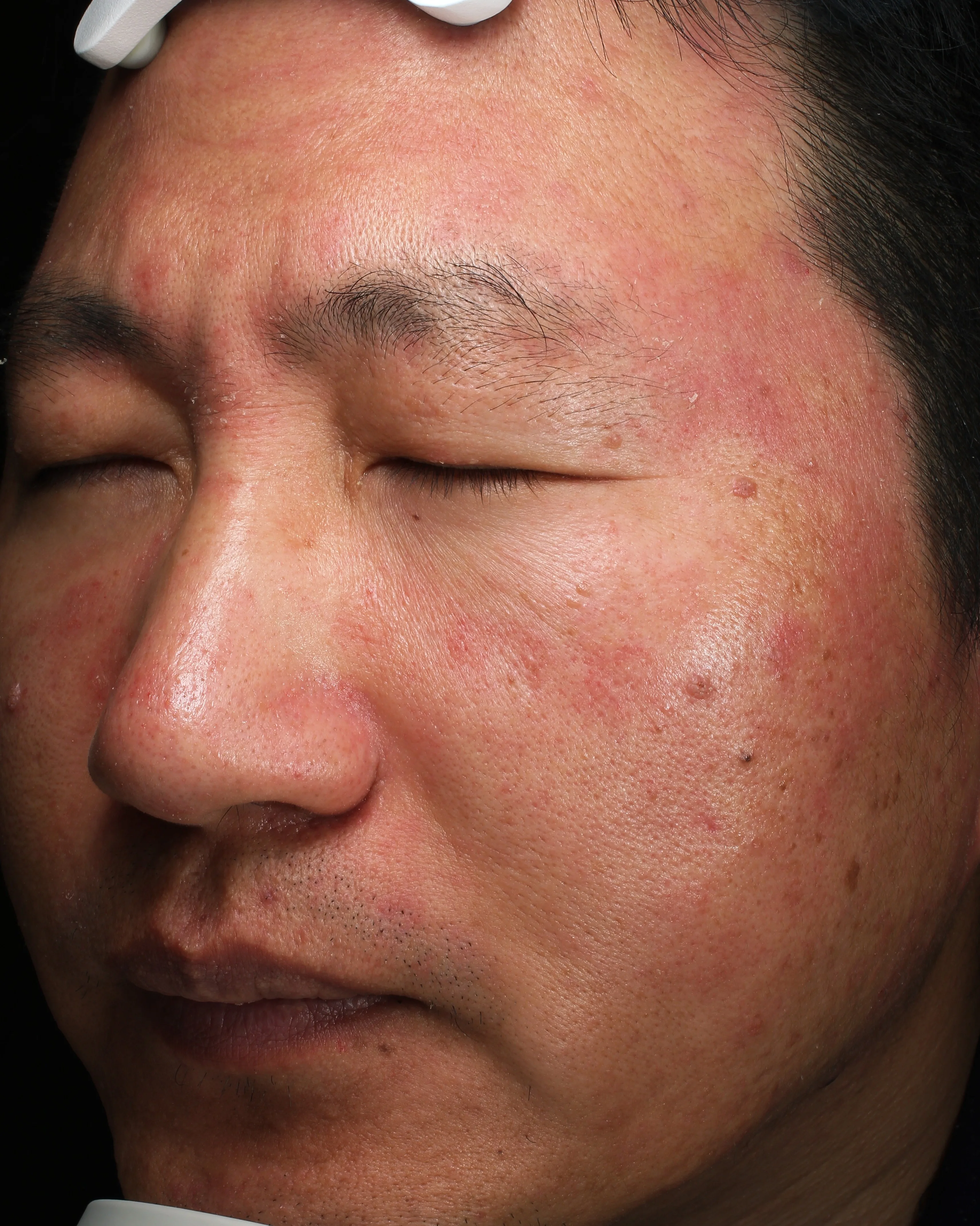 Sensitive Skin Pre-Treatment · Case 03 · Luowei Medical Aesthetics Clinic