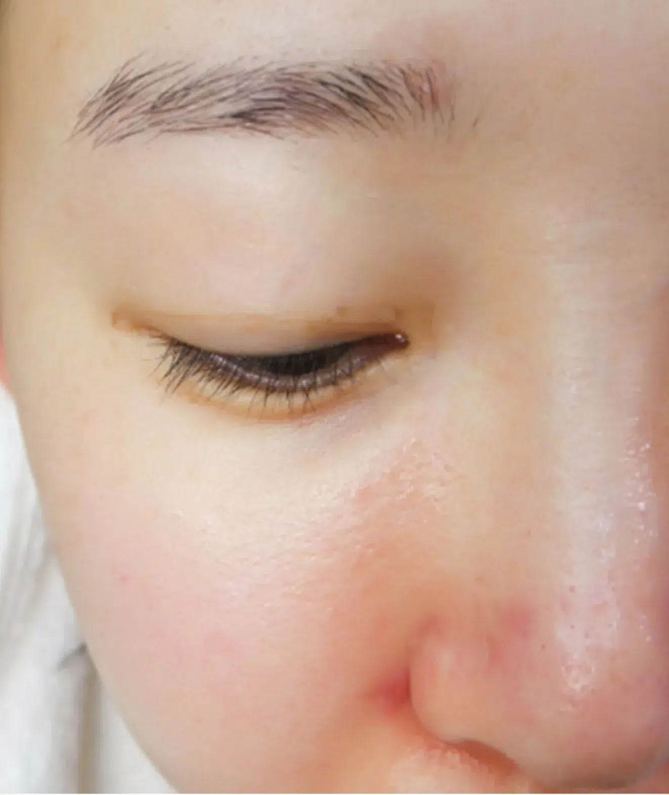 Facial Redness · Visible Vessels Before Treatment · Case 11 · Luowei Medical Aesthetics Clinic