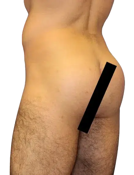Flat Buttocks, After · Case 18 · Luowei Medical Aesthetics Clinic