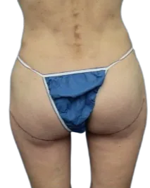 Flat Buttock · After Treatment · Case 5 · Luowei Medical Aesthetics Clinic