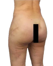 Flat Buttock · After Treatment · Case 7 · Luowei Medical Aesthetics Clinic
