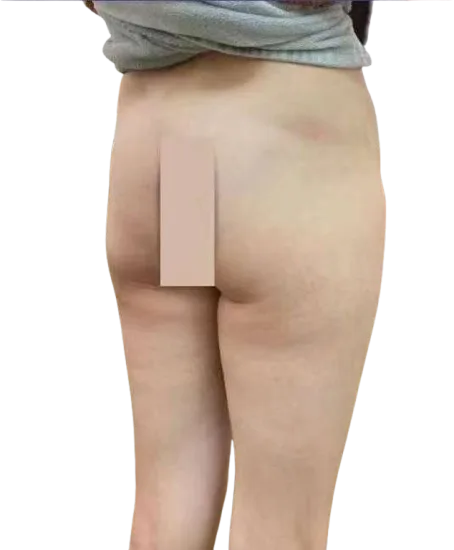 Flat Buttocks, Before · Case 3 · Luowei Medical Aesthetics Clinic