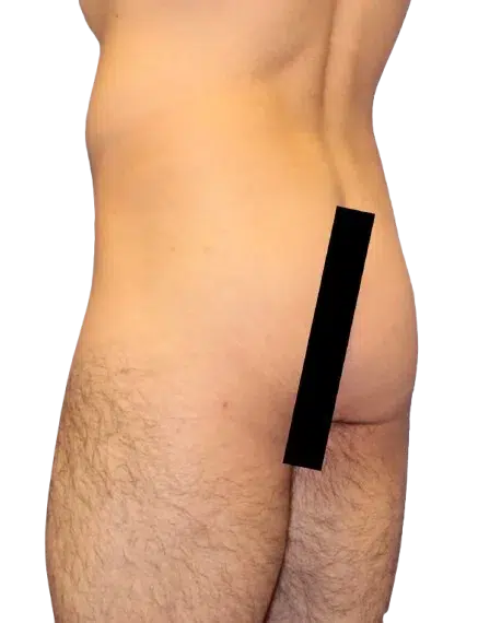 Flat buttocks Before · Case 18 · Luowei Medical Aesthetics Clinic