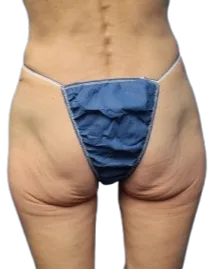 Flat Buttock — Before Treatment · Case 5 · Luowei Medical Aesthetics Clinic