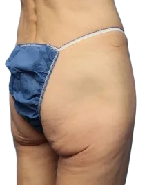 Flat Buttock · Before Treatment · Case 6 · Luowei Medical Aesthetics Clinic