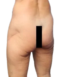 Flat Buttock — Before Treatment · Case 7 · Luowei Medical Aesthetics Clinic