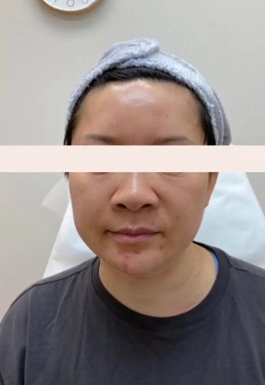 Forehead Lines — After Treatment · Case 01 · Luowei Medical Aesthetics Clinic